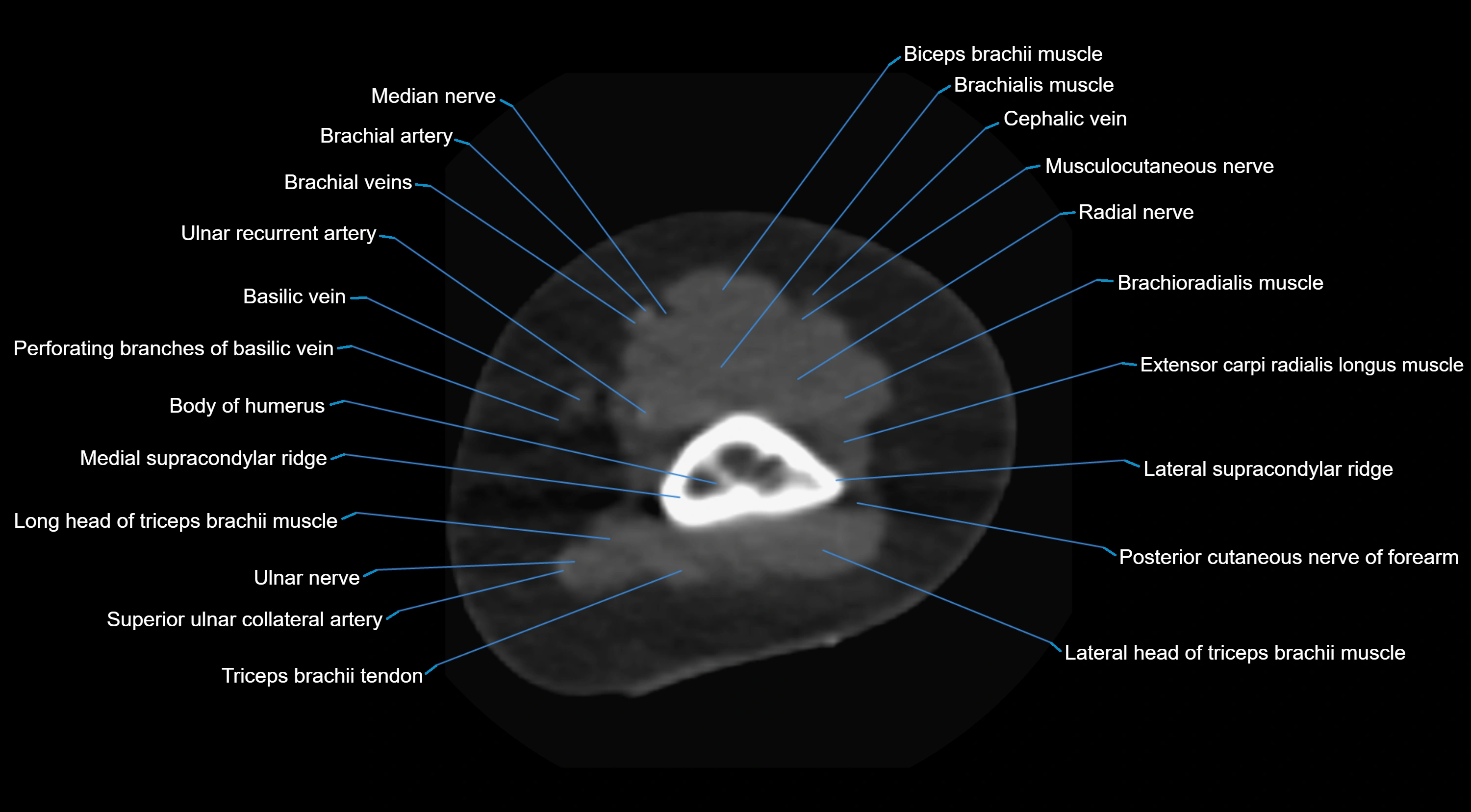 CT elbow axial  cross sectional anatomy labelled  radiology image -00004.webp